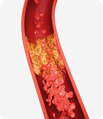 Cholesterol 