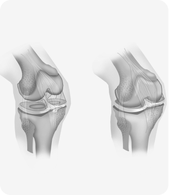 Cartilage