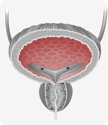 Inflammation